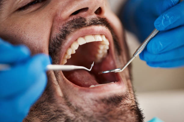 Best Walk-In Emergency Dentist in Bellview, FL